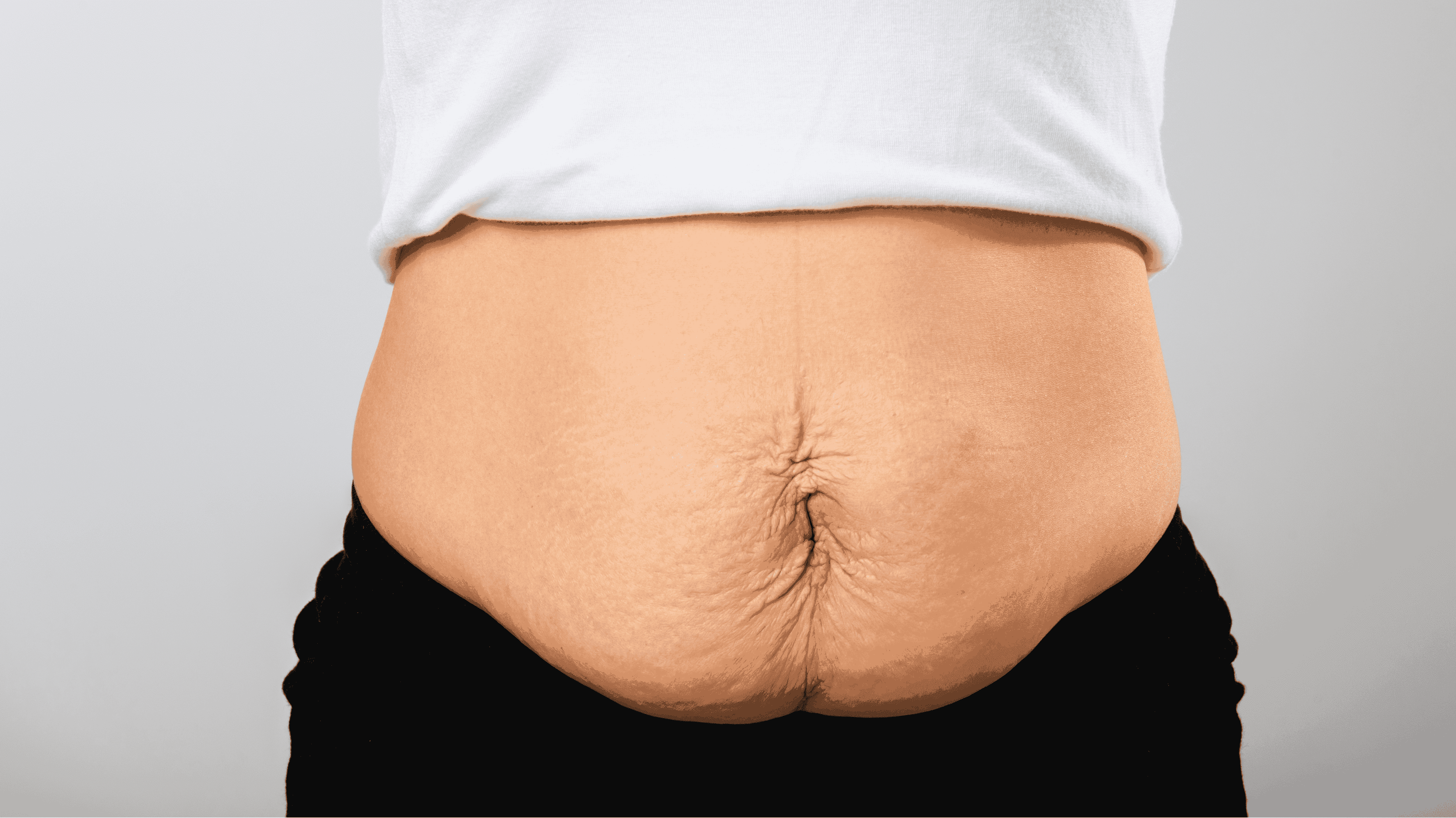 Cirugía después de la pérdida de peso: opciones y consideraciones