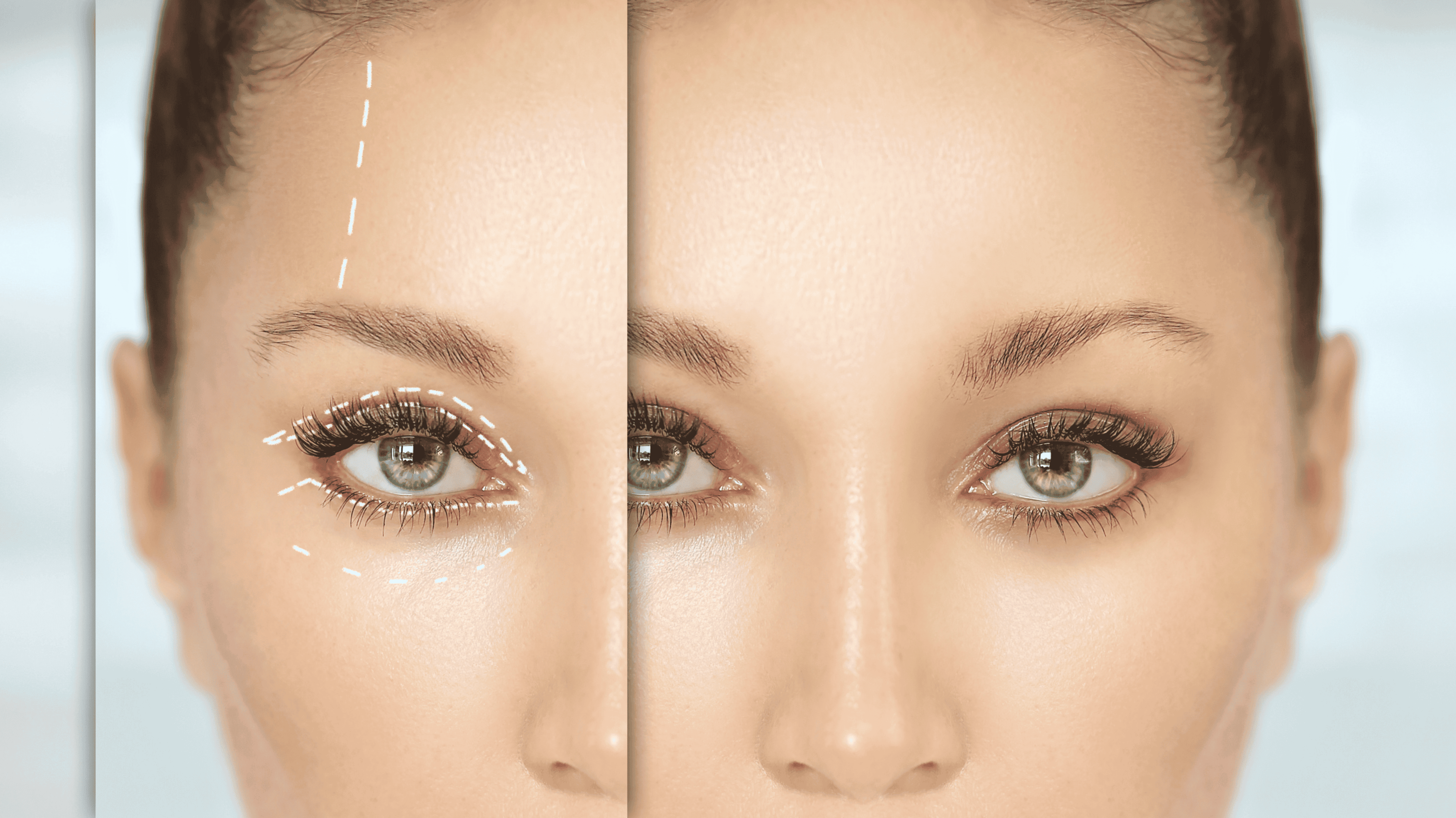 The facts about eyelid surgery