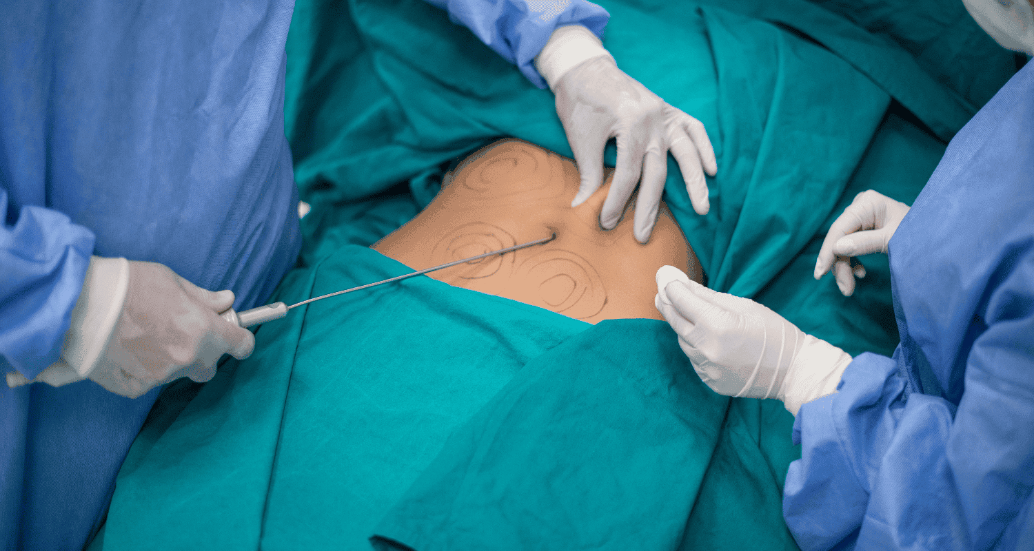 The risks of liposuction