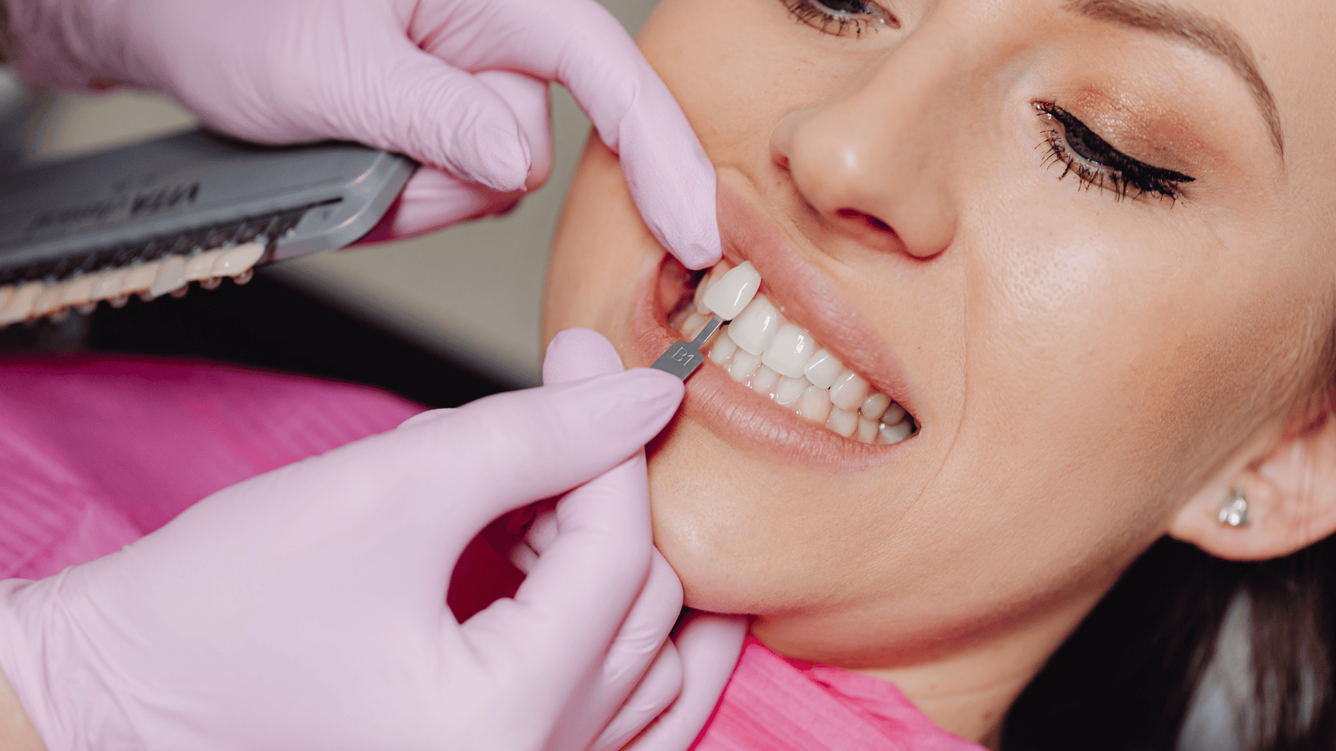 Worauf Sie bei der Platzierung von Zahn-Veneers achten sollten